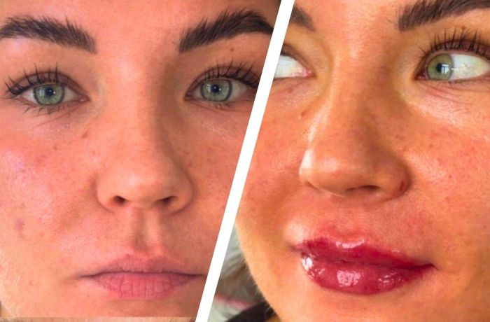 Split photo showing a before and after of a lip blush treatment