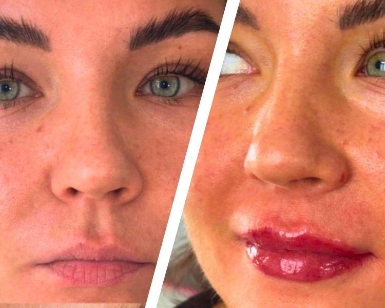 Split photo showing a before and after of a lip blush treatment